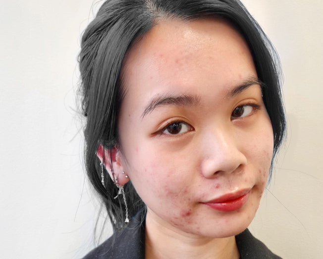 blog - adult-acne